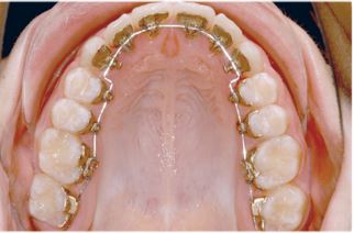 L’orthodontie linguale