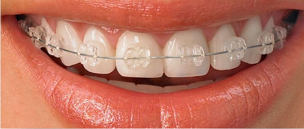 orthodontiques transparentes en céramique